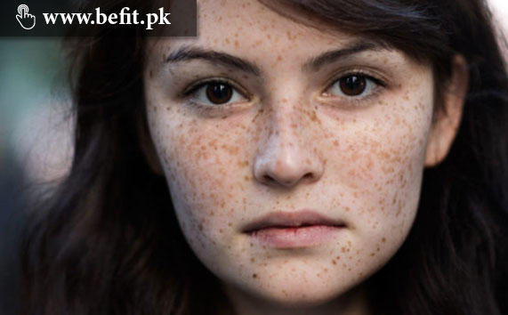 freckles کے