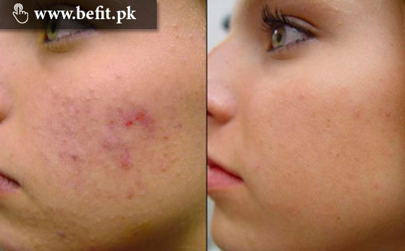 pimples کے علاج کے لئے کس طرح