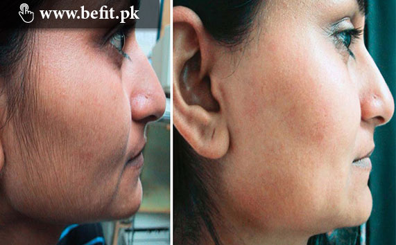 Remove Unwanted Hair from Face Permanently