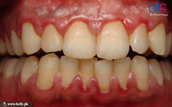 gums swelling